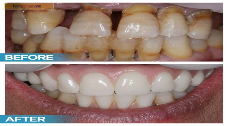 Dental Implant Before After