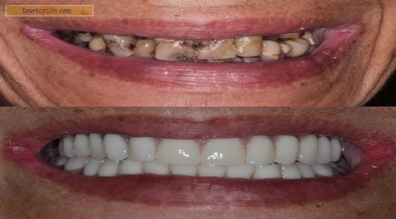Dental Implant Before After