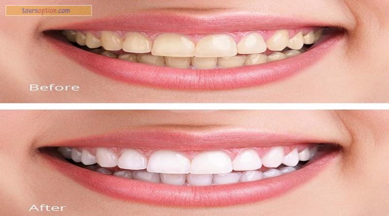 Teeth Whitening Before And After