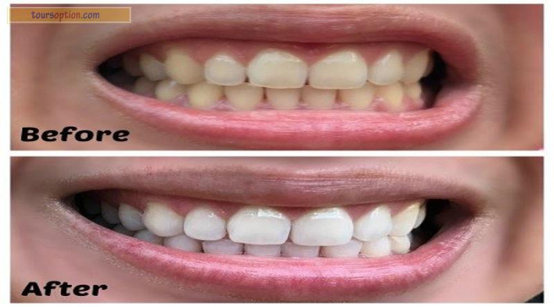 Teeth Whitening Before And After